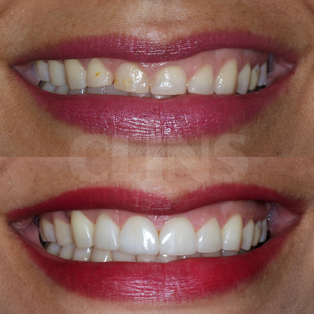 Antes e depois 1