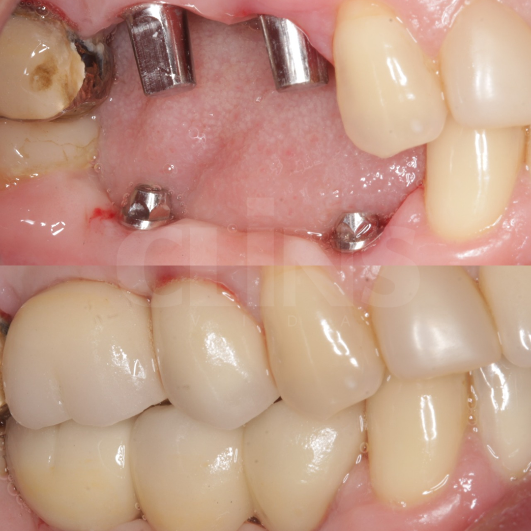 Antes e depois 11