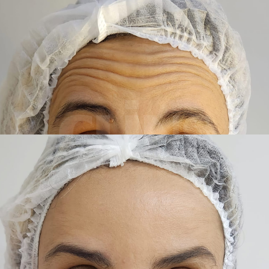 Antes e depois 14