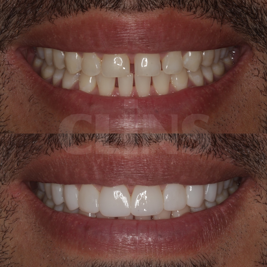 Antes e depois 2