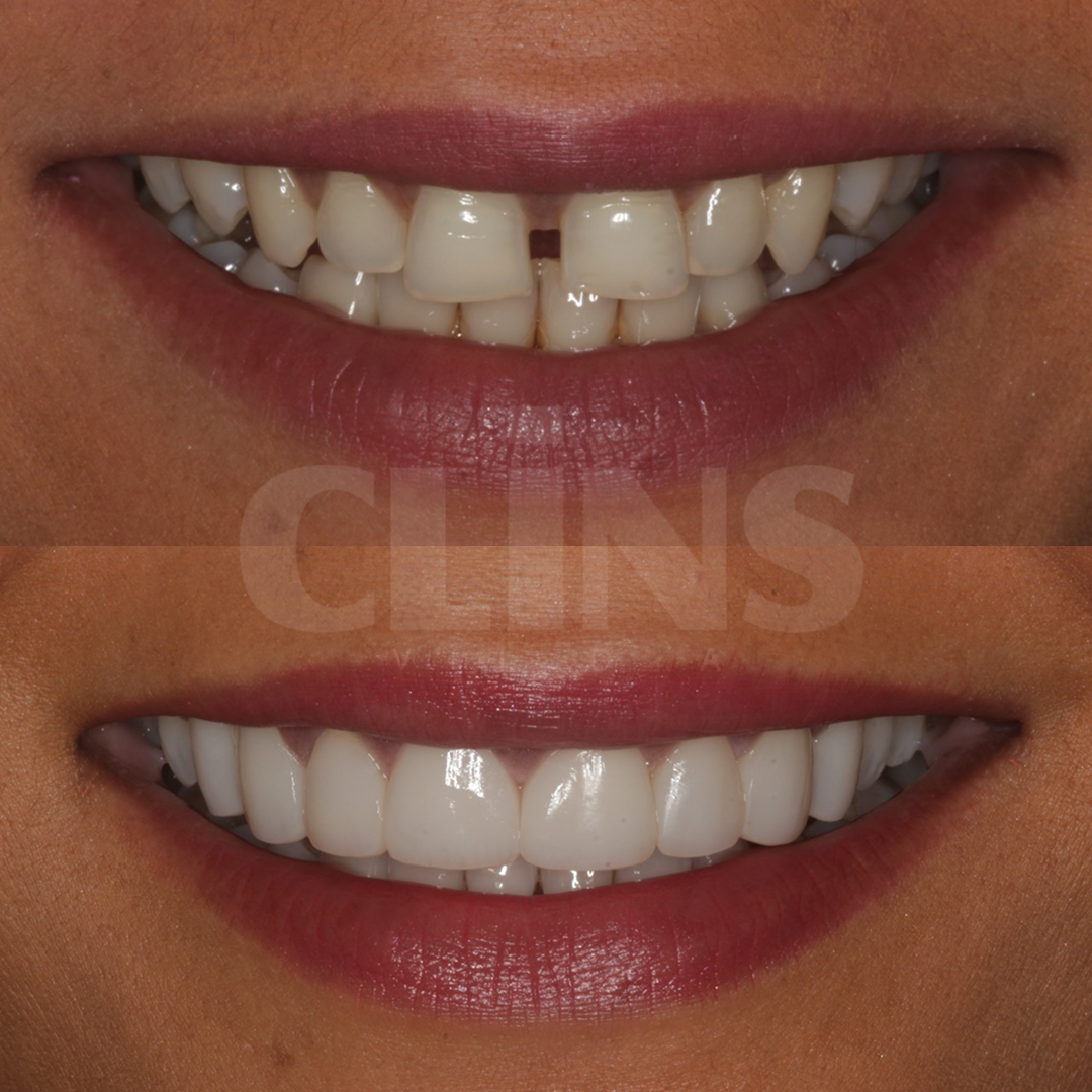 Antes e depois 3