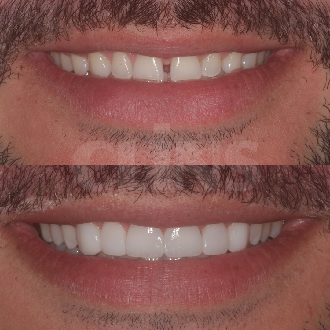 Antes e depois 4