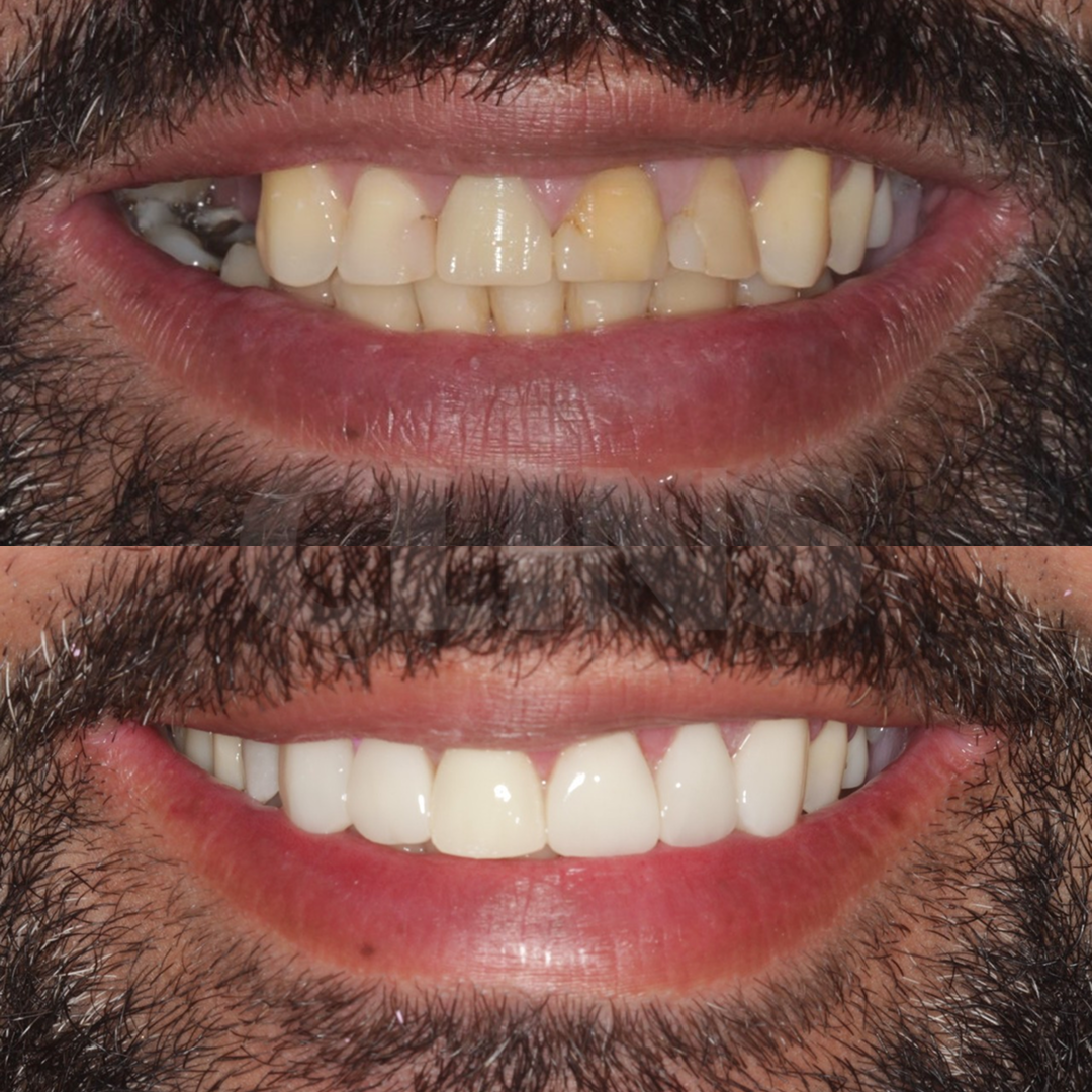 Antes e depois 5