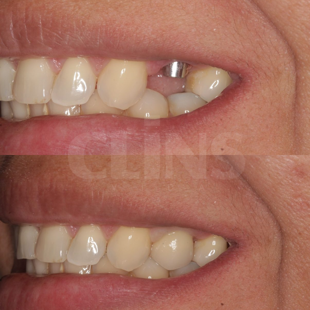 Antes e depois 6