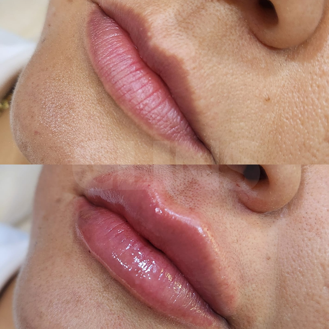 Antes e depois 8